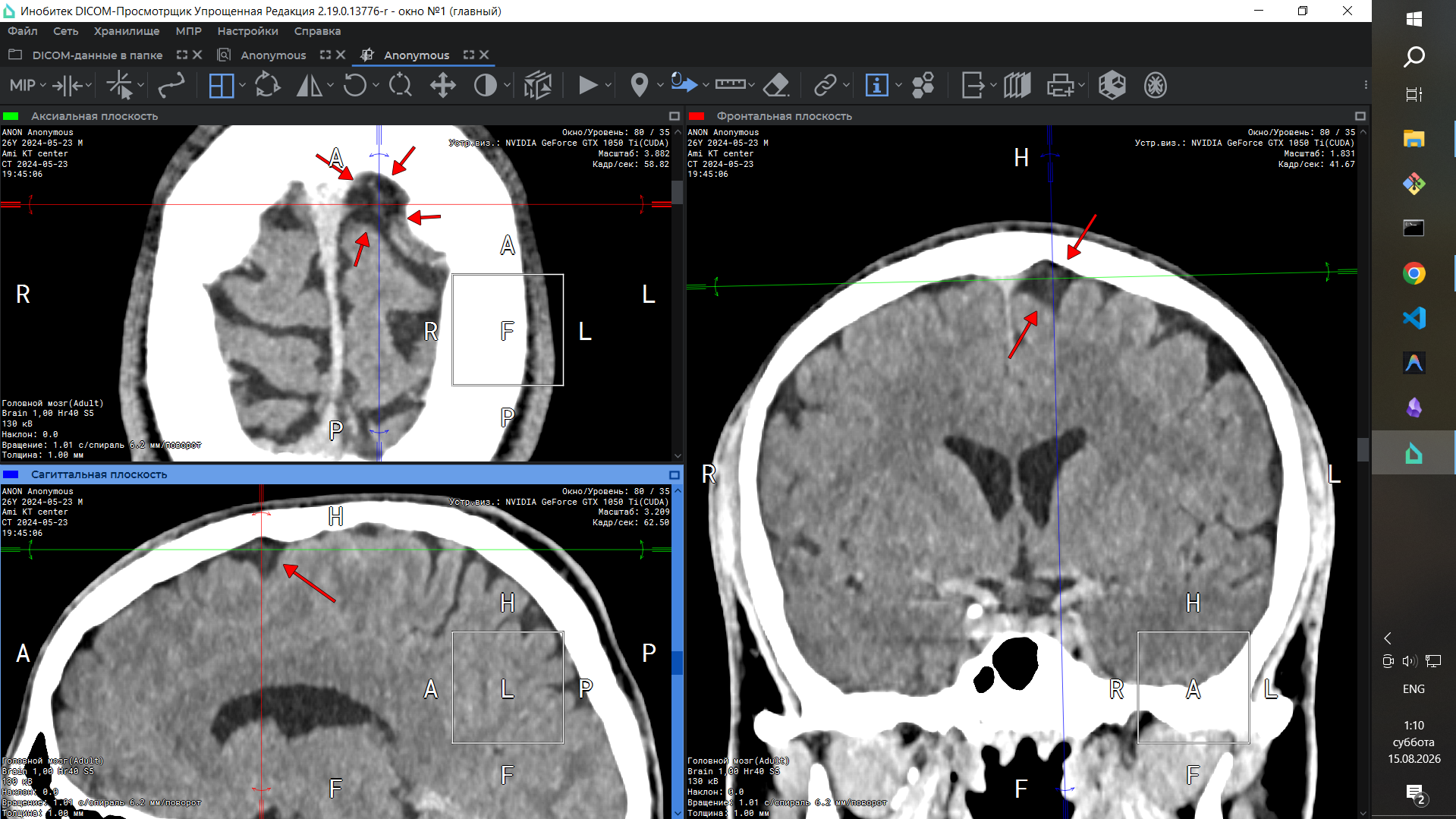 Illegal implant CT